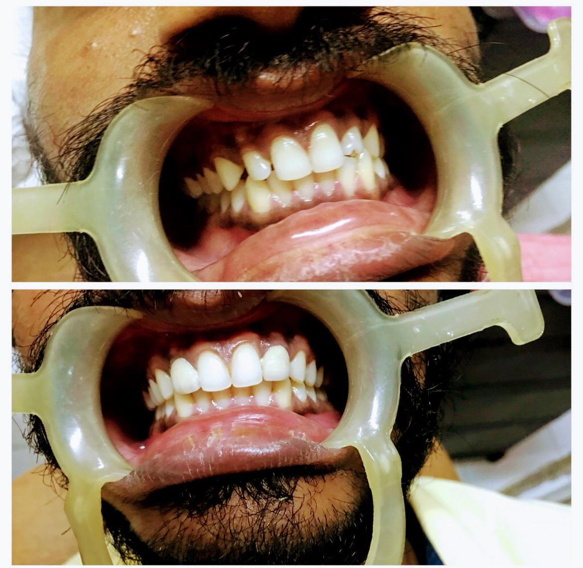 Smile Designing